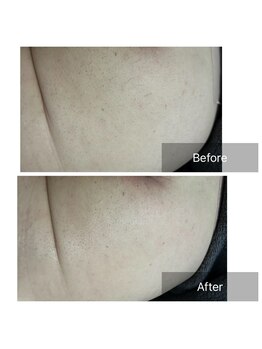 ダンニヒル(dannihil)/【おしりケア】50代会社員2回目