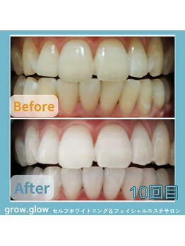 グロウ グロウ(grow.glow)/美容1回＋医療提携5回