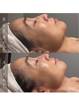 インフィニーズ(INFINEEZ)/カスタマイズ120分美肌改善50代