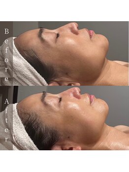 インフィニーズ(INFINEEZ)/カスタマイズ120分美肌改善50代