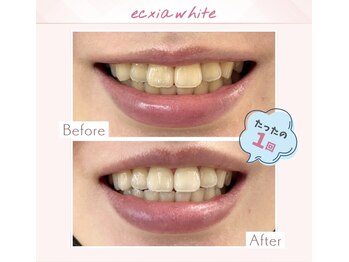 エクシアホワイトニング 調布店/20代女性会員様/1回目