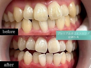 ホワイトニングカフェ 福岡天神店/◎歯のホワイトニング施術写真◎