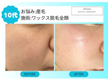 ムーンサン(Moon sun)/お顔　全顔ワックス脱毛