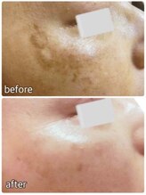 ブランシェ 高岡店 × 椿/シミケア　お客様