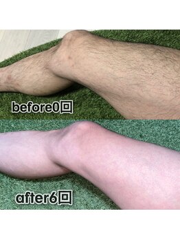 ボウイズ 磐田店(BOYZ)/下半身脱毛　6回　before after