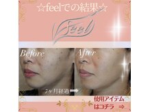 エステティックサロン フィール(feel)