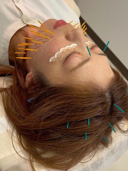 樹美容鍼灸整体院 烏丸御池の写真/【美容鍼/お肌のお悩み改善♪】お肌の内側からアプローチし、シミ・たるみケア!リフトアップ効果も◎