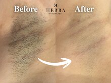 ヘルバ(HERBA)/脱毛