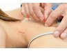 お身体の鍼灸施術60分　体の痛み不調・自律神経の不調がある方！肩こり、腰痛