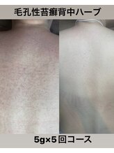 ウィズサロン 天神大名店(withサロン)/背中毛孔性ハーブピーリング