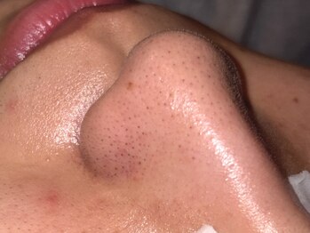 クラウン(CROWN)の写真/話題の天然温泉成分で毛穴の汚れや角栓、黒ずみをしっかりケア！お肌も小鼻ももちもちツルツルに♪