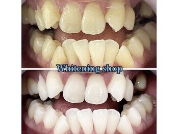 ホワイトニングショップ 三島店(WHITENING SHOP)/歯の並び悪い方でも大丈夫♪