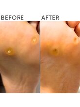 クオッカ(Quokka)/たこ・魚の目ケア