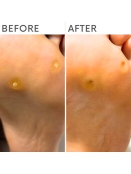 クオッカ(Quokka)/たこ・魚の目ケア