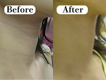 ビースキン 広島(BE:SKIN)/ミネラルピーリング/ニキビケア