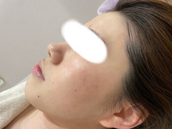 ビューティーサロン アンド ユー シブヤ(Beauty Salon&U Shibuya)/肌質改善施術1回後