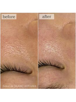 サロン ド ブラン アオヤマ(Salon de BLANC AOYAMA)/クリスティーナ美白ケア