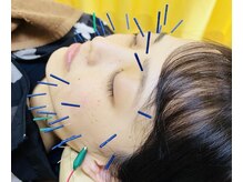 松本接骨院 中野の雰囲気（美容鍼もオススメ♪【小顔/リフトアップ/ほうれい線/美容】）