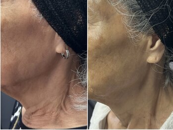 ラニー アンド ココネイル(LANIE&CocoNail)/隠しきれないお首のシワも！