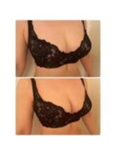 美人バスト 表参道店/【バストアップ/育乳 症例】