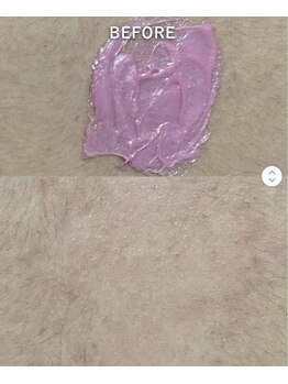 サロン あいん(Salon)/Wax脱毛