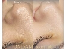 オンダム 表参道(ONDAM)/セラピールで毛穴・くすみ改善◎