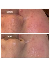 ビビ(VIVI)/赤ら顔・肌トラブル改善に◎