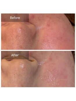 ビビ(VIVI)/赤ら顔・肌トラブル改善に◎