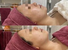 GRACETHOUSAND(グレイスサウザンド)/ハーブピーリング/くすみ