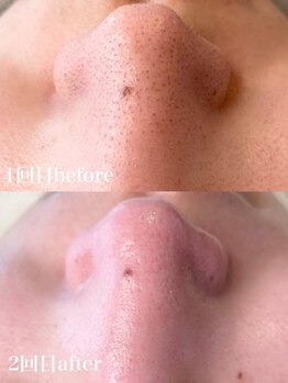 リュクスルーム(Luxe room)/３D毛穴洗浄×潤艶WAX脱毛１回