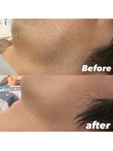 メンズエムボーテ 太田店(Men's M BEAUTE33)/【ヒゲ脱毛】