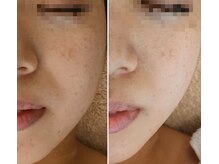 アルモ(ALMO)/スッキリ小顔へアップデート！