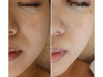 アルモ(ALMO)/スッキリ小顔へアップデート！