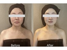 クレシア(CRECIA)/コルギ＋ハーブピーリング