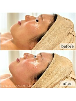 サロン ド ブラン アオヤマ(Salon de BLANC AOYAMA)/クリスティーナ美白ケア