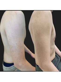 リベル 名古屋(Lebelle:)/ハーブピーリング専門名古屋