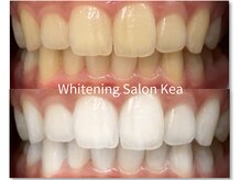 【圧倒的効果】歯科提携過酸化水素ジェル※詳細はスタッフ掲載欄