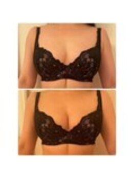 美人バスト 表参道店/【バストアップ/育乳 症例】