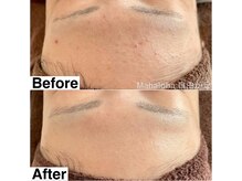 マハロハ 自由が丘(Mahaloha)/【額のザラつき・肌荒れ改善】