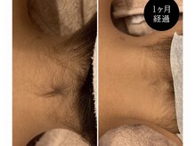 アンジェ(Ange)/うなじ脱毛で後ろ姿まで美しく♪