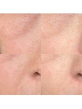 サロン シェリー 大島(Salon Cherie)/光フェイシャル