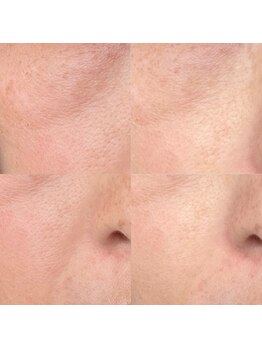 サロン シェリー 大島(Salon Cherie)/光フェイシャル