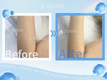 ストラッシュ 千葉店(STLASSH)/施術例:ひじ下