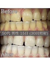 シカホワイトニングトウキョウ 笹塚店(CICA Whitening Tokyo)/ビフォーアフター(50代男性）