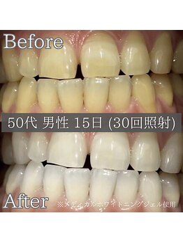シカホワイトニングトウキョウ 笹塚店(CICA Whitening Tokyo)/ビフォーアフター(50代男性)