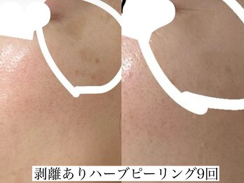 アリス(ALICE)/シミも毛穴もハーブピーリング