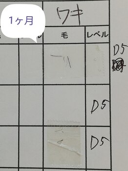 RiとBiのたまご/(速効脱毛　)ワキ脱毛　毛の深さ