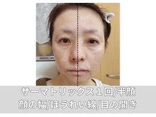 リジュベネーションサロン アリス(Alice)/サーマトリックス半顔のみ