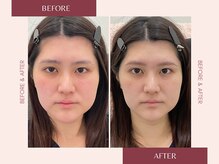 ナキ 富山店(Naki)/眉毛施術例 (眉毛Before.After)