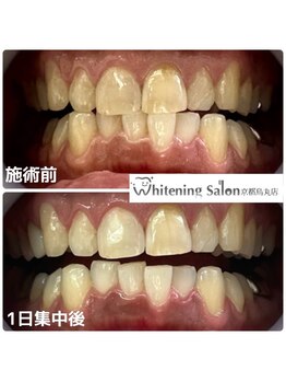 ホワイトニングサロン 京都烏丸店/ホワイトニング施術例
